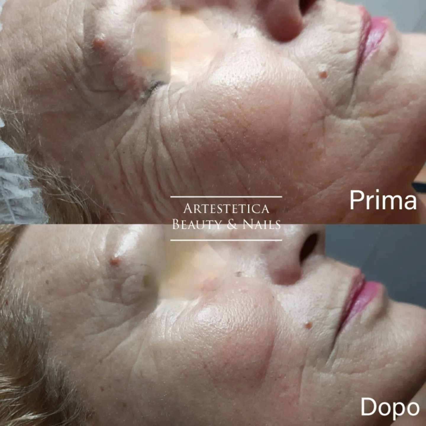 Risultato viso condiviso da Artestetica Beauty & Nails